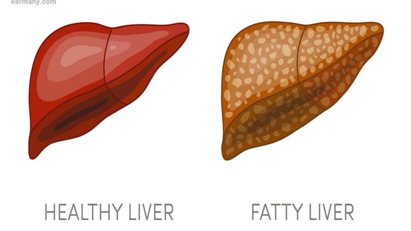 types-fatty-liver-8