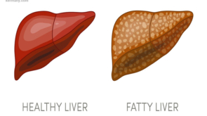 types-fatty-liver-8